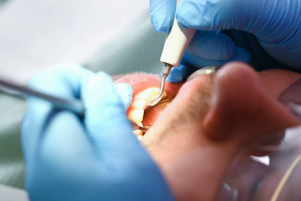 Best Emergency Treatment for Dental Infections or Abscesses in Hockinson, WA