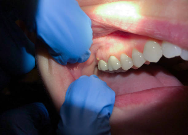 Best Emergency Wisdom Teeth Removal in Hockinson, WA